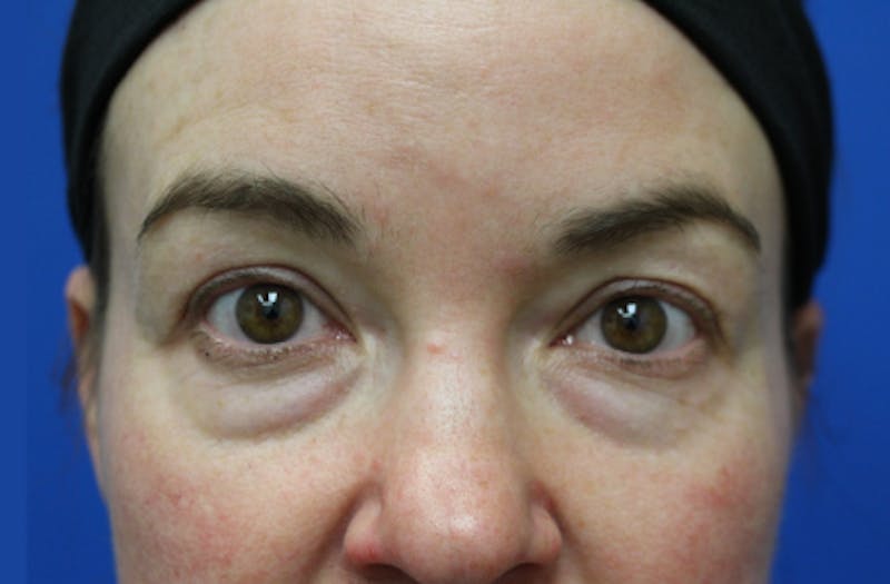 Lower Eyelid Surgery Before & After Gallery - Patient 112527 - Image 1