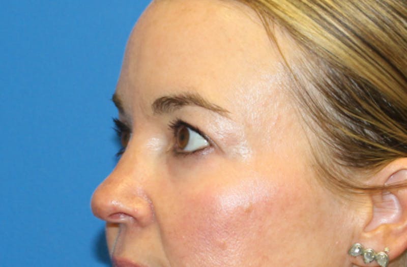 Lower Eyelid Surgery Before & After Gallery - Patient 112527 - Image 4