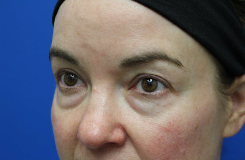 Lower Eyelid Surgery Before & After Gallery - Patient 112527 - Image 3