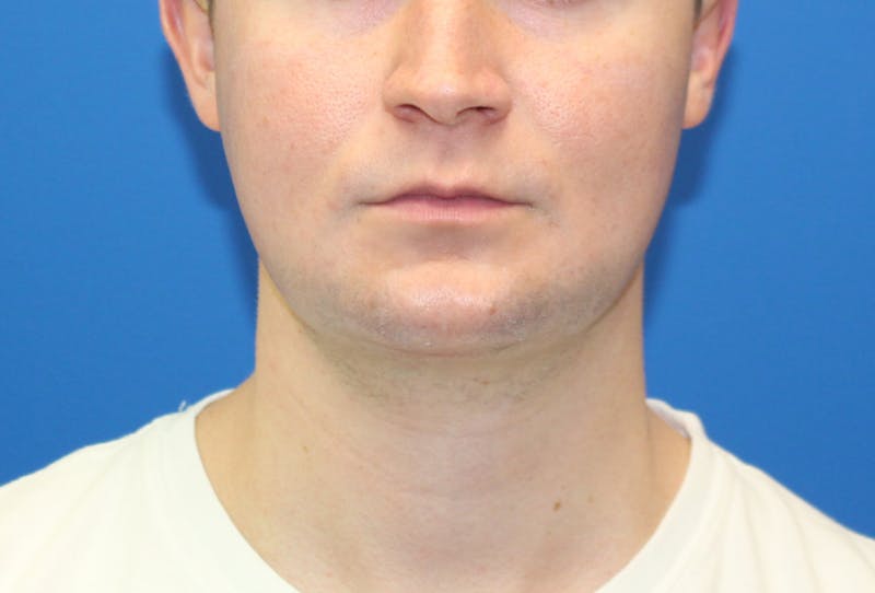 Neck Lift Before & After Gallery - Patient 257093 - Image 6