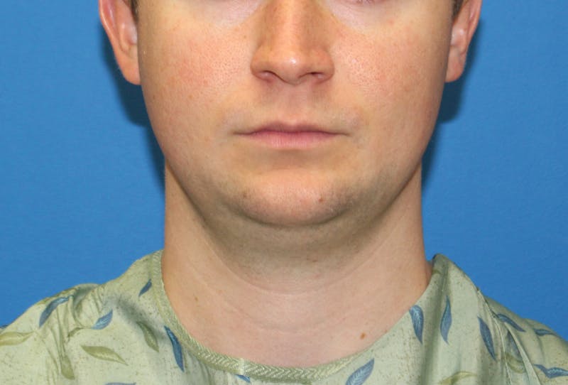 Neck Lift Before & After Gallery - Patient 257093 - Image 5
