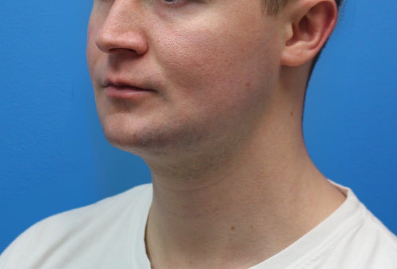 Neck Lift Before & After Gallery - Patient 257093 - Image 4