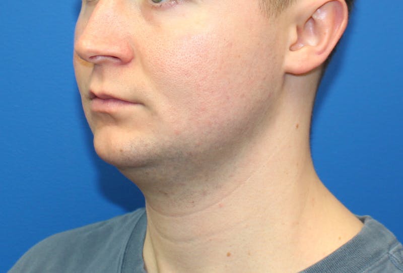 Neck Lift Before & After Gallery - Patient 257093 - Image 3
