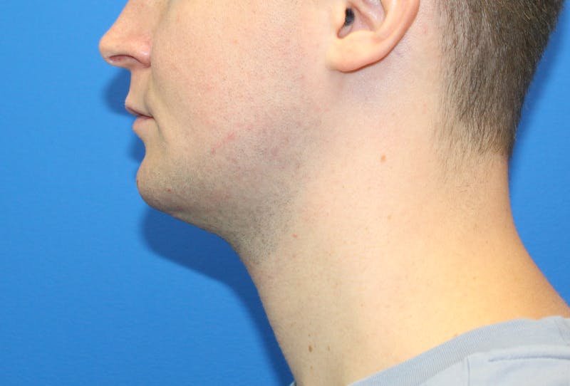 Neck Lift Before & After Gallery - Patient 257093 - Image 2