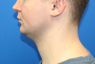 Platysmaplasty Before & After Gallery - Patient 217525 - Image 1