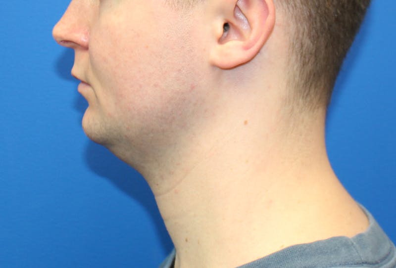 Neck Lift Before & After Gallery - Patient 257093 - Image 1
