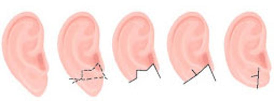 earlobe repair infographic