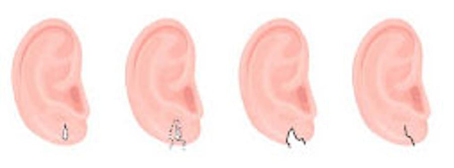 earlobe repair infographic