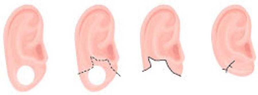 earlobe repair infographic