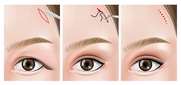 brow lift infographic
