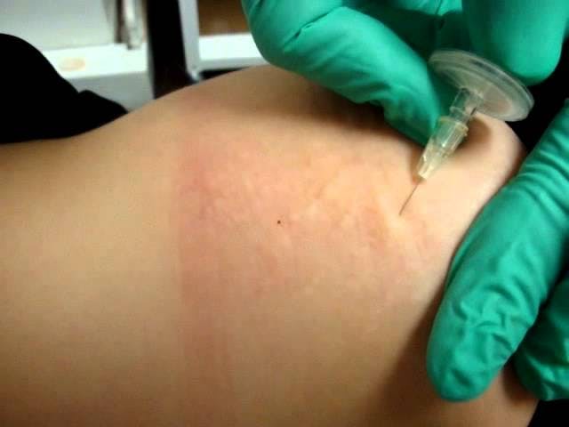 stretch mark thumbnail