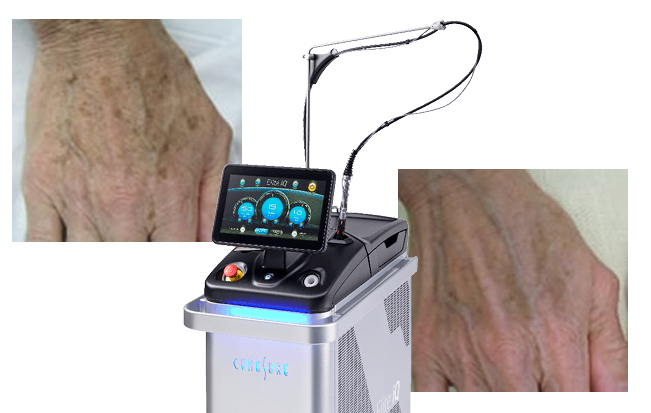 laser system