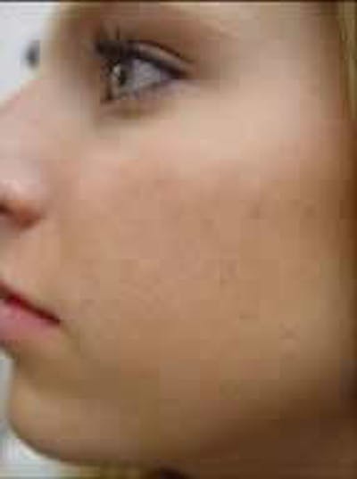 Acne Treatment Before & After Gallery - Patient 424866 - Image 1
