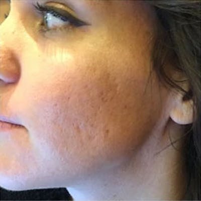 Aquagold Before & After Gallery - Patient 110231 - Image 1