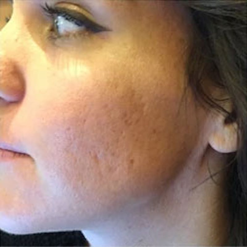 Aquagold Before & After Gallery - Patient 110231 - Image 1