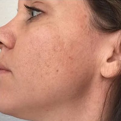 Aquagold Before & After Gallery - Patient 110231 - Image 2