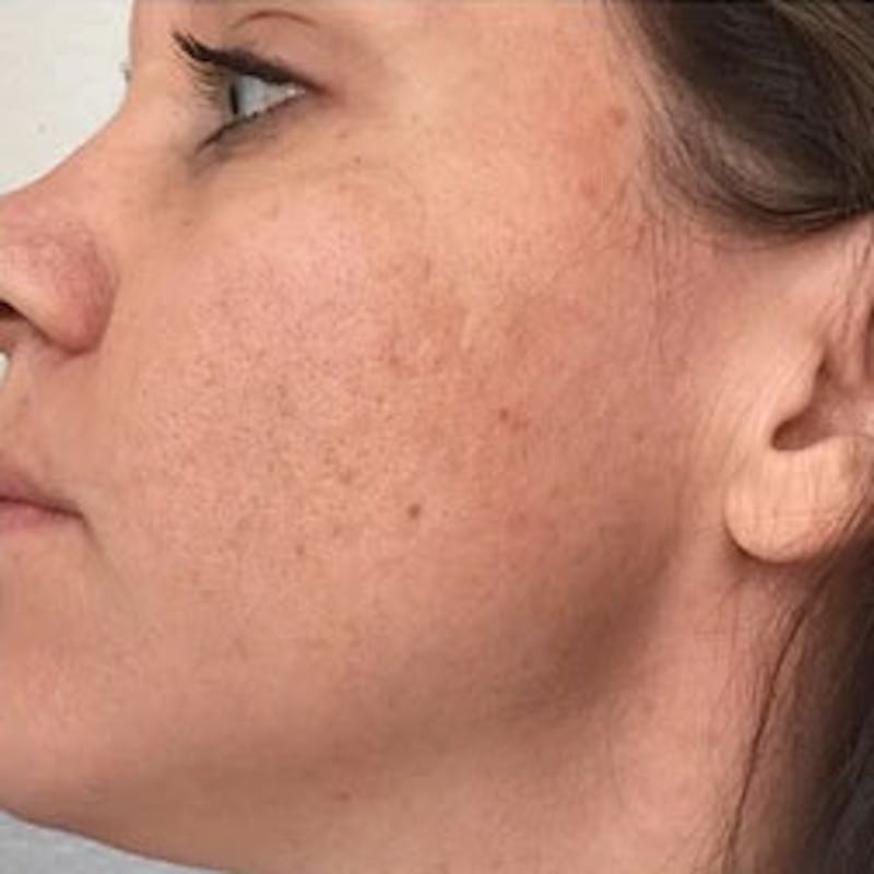Aquagold Before & After Gallery - Patient 110231 - Image 2