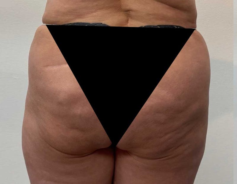 Brazilian Butt Lift (BBL) Before & After Gallery - Patient 114490 - Image 1