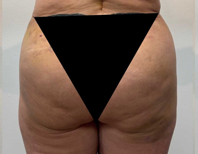 Brazilian Butt Lift (BBL) Before & After Gallery - Patient 114490 - Image 2