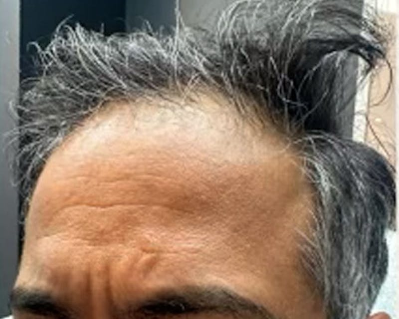 Exosomes Therapy (Hair Loss) Before & After Gallery - Patient 368673 - Image 2