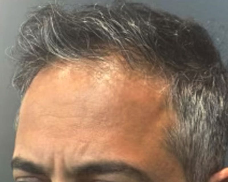 Exosomes Therapy (Hair Loss) Before & After Gallery - Patient 368673 - Image 1