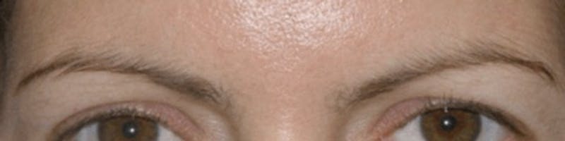 Eyebrow Transplant Before & After Gallery - Patient 233377 - Image 1