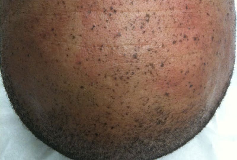 Freckle and Sun-Spot Removal Before & After Gallery - Patient 168946 - Image 1
