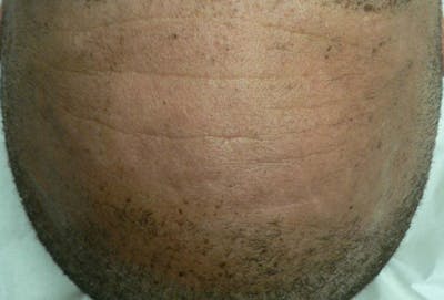 Freckle and Sun-Spot Removal Before & After Gallery - Patient 168946 - Image 2