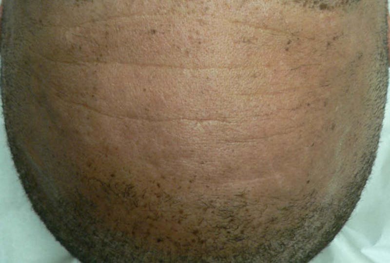 Freckle and Sun-Spot Removal Before & After Gallery - Patient 168946 - Image 2
