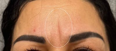 Glabellar Fillers Before & After Gallery - Patient 412444 - Image 1