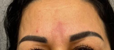 Glabellar Fillers Before & After Gallery - Patient 412444 - Image 2