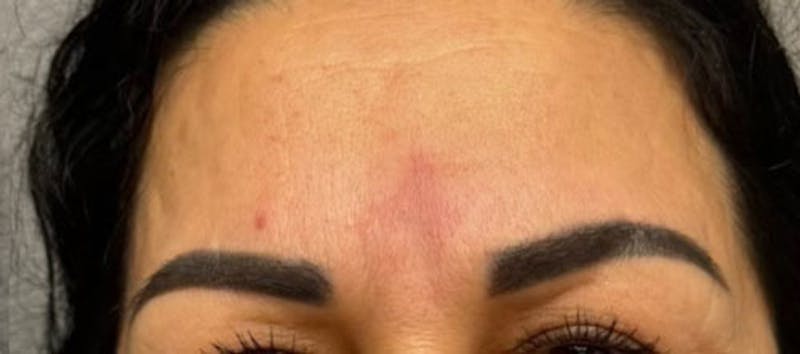 Glabellar Fillers Before & After Gallery - Patient 412444 - Image 2
