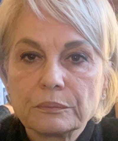 Liquid Mini Facelift and Anti-Aging Before & After Gallery - Patient 822595 - Image 1