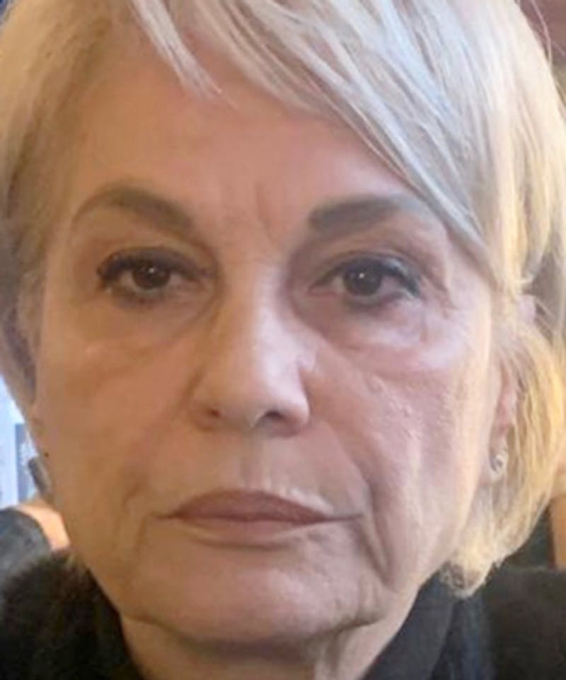 Liquid Mini Facelift and Anti-Aging Before & After Gallery - Patient 822595 - Image 1