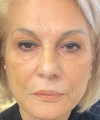 Liquid Mini Facelift and Anti-Aging Before & After Gallery - Patient 822595 - Image 2