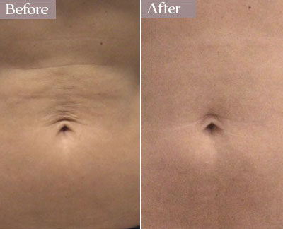 morpheus8 results