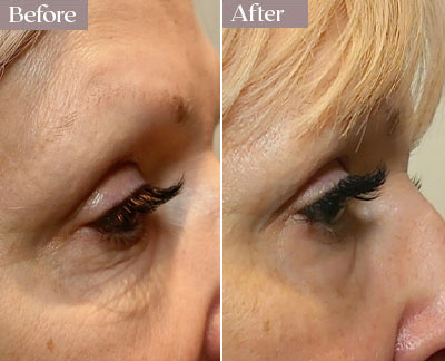 morpheus8 results