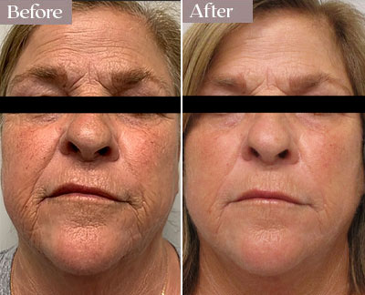 morpheus8 results