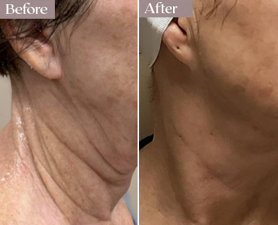 morpheus8 results