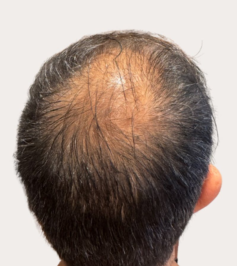 Rx and Products (Hair Restoration) Before & After Gallery - Patient 277327 - Image 1