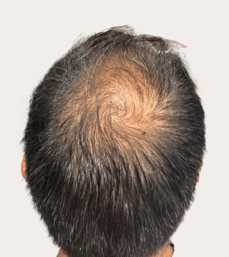 Rx and Products (Hair Restoration) Before & After Gallery - Patient 277327 - Image 2