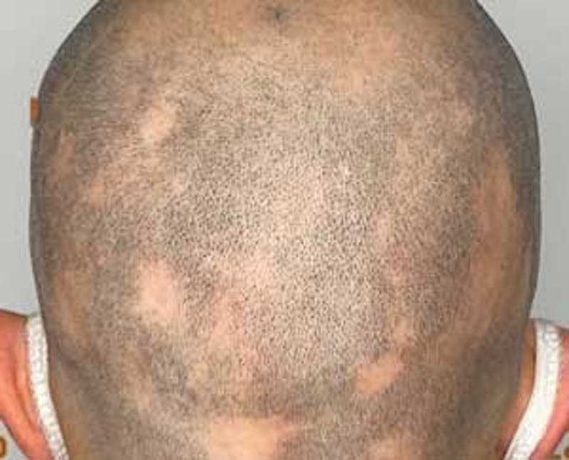 Scalp Micropigmentation Before & After Gallery - Patient 243054 - Image 1