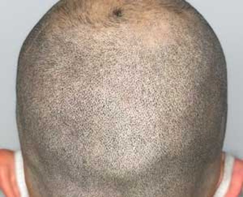 Scalp Micropigmentation Before & After Gallery - Patient 243054 - Image 2