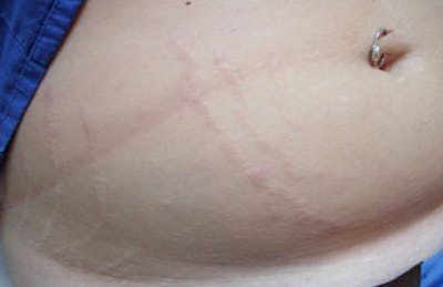 Stretch Mark (Carboxy) Before & After Gallery - Patient 456561 - Image 1