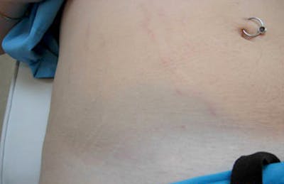 Stretch Mark (Carboxy) Before & After Gallery - Patient 456561 - Image 2