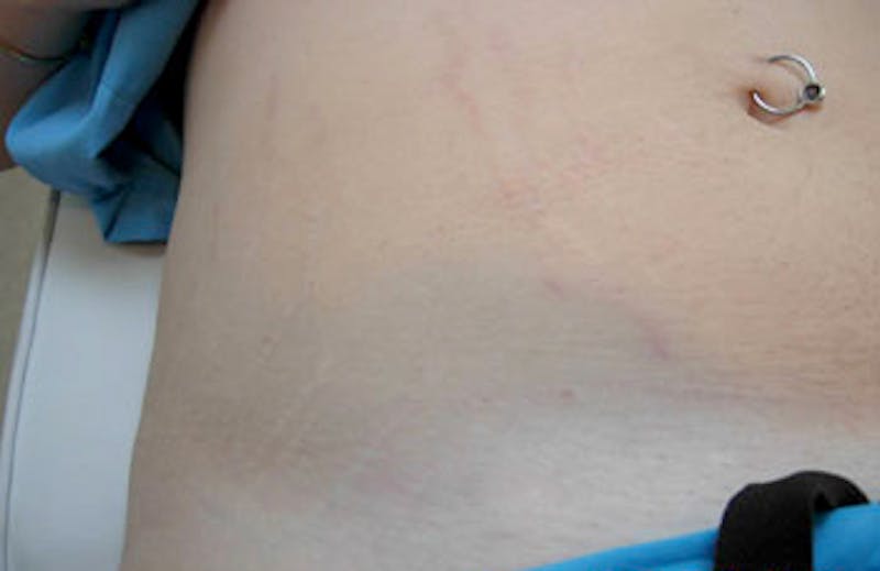 Stretch Mark (Carboxy) Before & After Gallery - Patient 456561 - Image 2