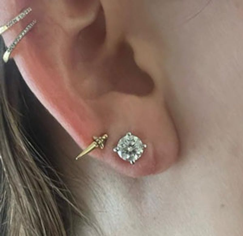 Torn Earlobe Repair Before & After Gallery - Patient 171413 - Image 2