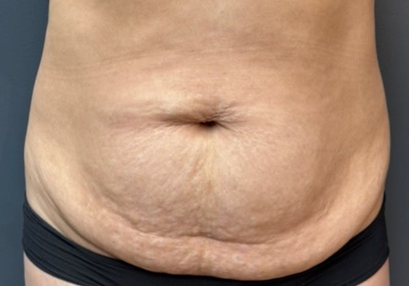 Tummy Tuck Before & After Gallery - Patient 289422 - Image 1