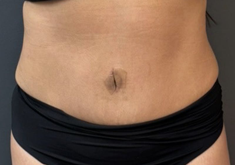Tummy Tuck Before & After Gallery - Patient 289422 - Image 2