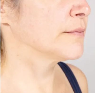 Ultherapy Skin Tightening Before & After Gallery - Patient 283797 - Image 1